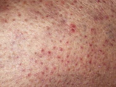 FIGURE 14-22, Syringotropic mycosis fungoides manifesting as multiple small red papules.