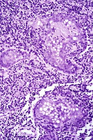 FIGURE 14-24, Syringotropic mycosis fungoides with many atypical lymphocytes involving the sweat ducts.