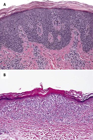 FIGURE 14-25, Pagetoid reticulosis. A, Most of the atypical lymphocytes are clustered at the dermal-epidermal junction. B, Hyperchromatic lymphocytes show irregular nuclear contours.