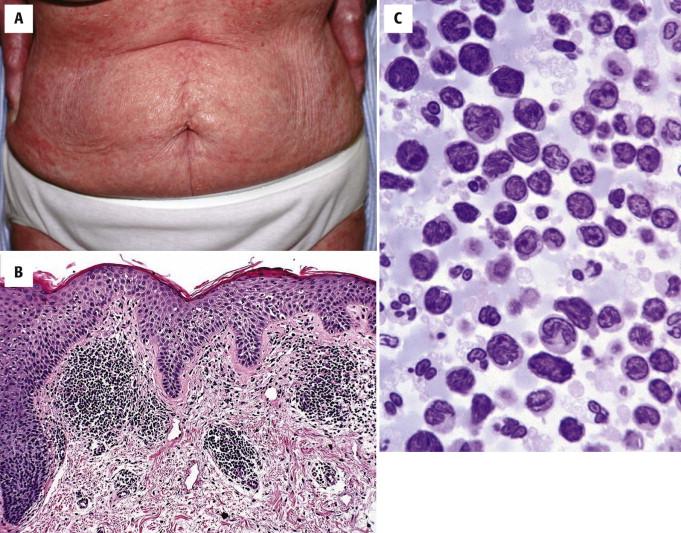 FIGURE 14-27, Sézary syndrome. A, Erythroderma. B, Lymphocytic infiltrate with epidermotropism and mild spongiosis. C, Sézary cells in peripheral blood (buffy coat).