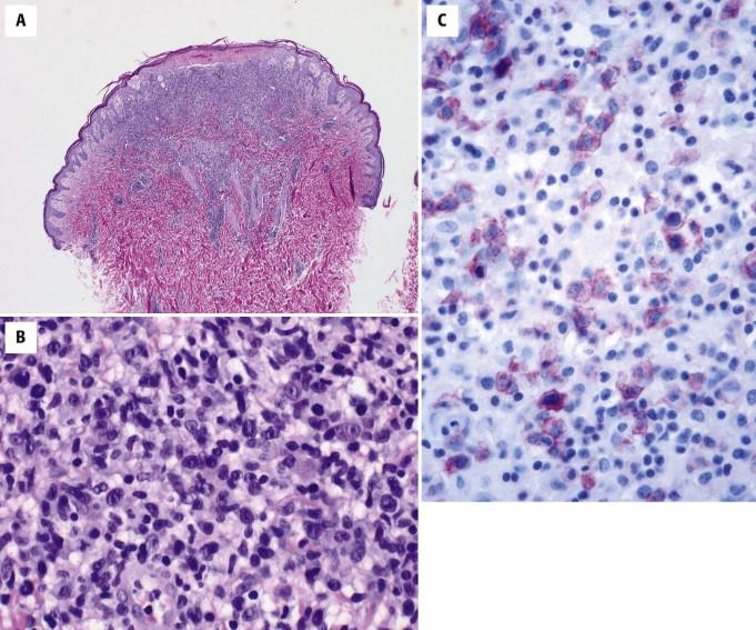 FIGURE 14-29, Lymphomatoid papulosis. A, Papular lesion with wedge-shaped lymphocytic infiltrate. B, A mixed infiltrate of small and large lymphocytes is present. C, The subpopulation of large cells is positive for CD30.