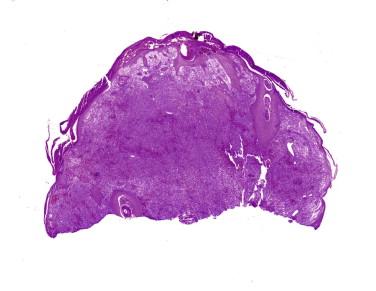 FIGURE 14-32, Silhouette of an anaplastic large cell lymphoma. A dense infiltrate is associated with epidermal hyperplasia.