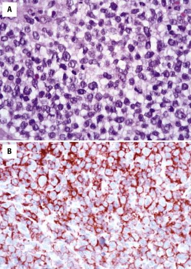 FIGURE 14-33, CD30-positive large cell lymphoma. A, The infiltrate is composed of large cells. B, They are immunoreactive for CD30.