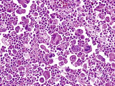 FIGURE 14-34, The large anaplastic cells are intermingled with numerous neutrophils and eosinophils.