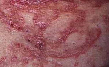 FIGURE 14-5, Polycyclic lesion of mycosis fungoides.