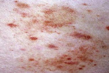 FIGURE 14-7, Pigmented purpuric mycosis fungoides.