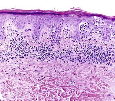 FIGURE 14-8, Mycosis fungoides. Lichenoid pattern with atypical epidermotropic lymphocytes and Pautrier's microabscesses.