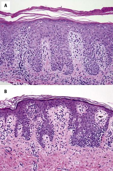 FIGURE 14-9, Mycosis fungoides. A, Psoriasiform pattern with atypical epidermotropic lymphocytes. B, Hyperchromatic lymphocytes are peppered along elongated rete ridges.