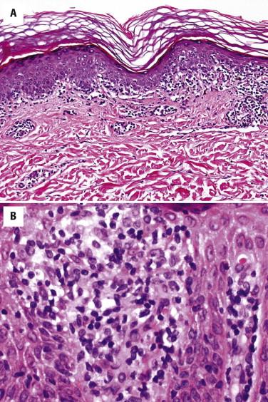 FIGURE 14-10, Mycosis fungoides. A, Lymphocytes are lined up (“tag along”) at the dermal-epidermal junction. B, The epidermotropic lymphocytes have hyperchromatic nuclei.