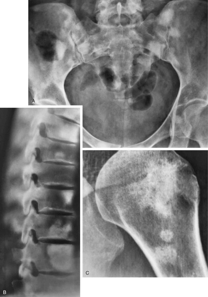 FIGURE 12-11, Sclerosing plasma cell myeloma: radiographic features.