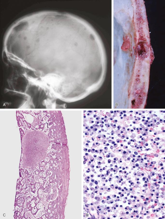 FIGURE 12-12, Plasma cell myeloma: radiographic, gross, and microscopic features.