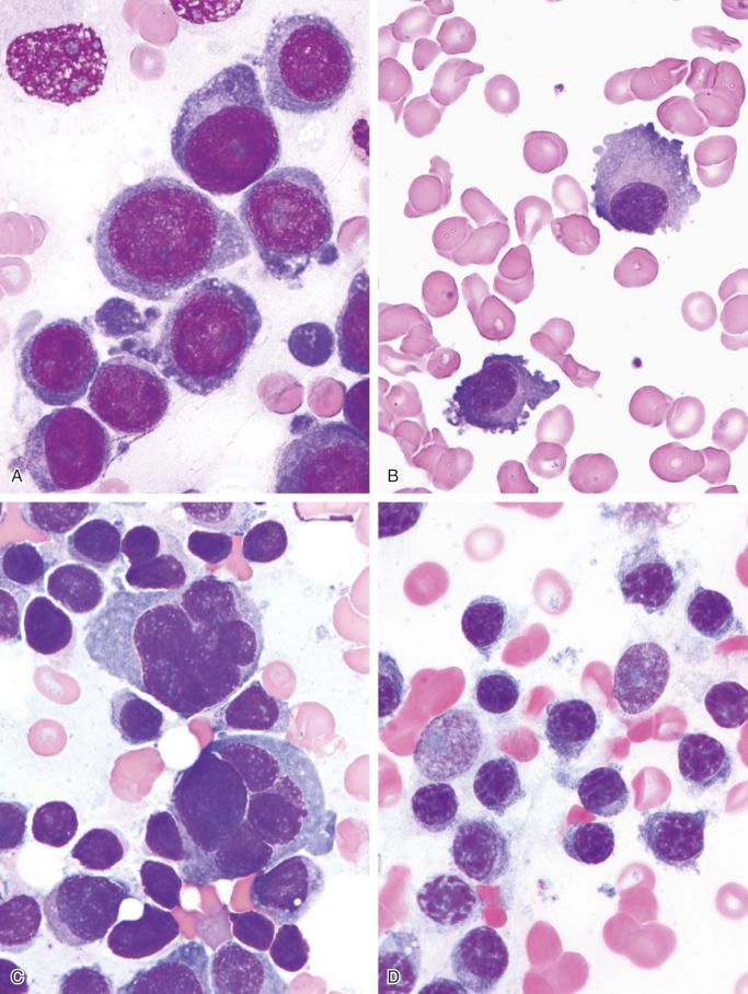 FIGURE 12-13, Plasma cell myeloma: cytologic features.