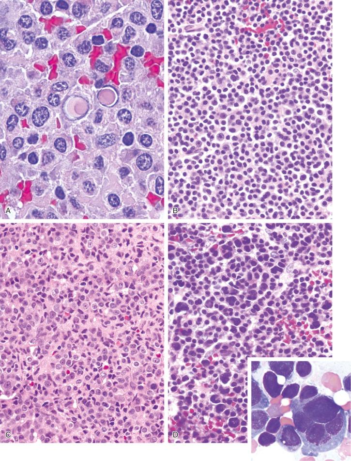 FIGURE 12-14, Plasma cell myeloma: microscopic features.