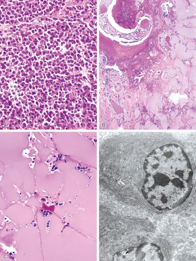 FIGURE 12-16, Plasma cell myeloma: microscopic and ultrastructural features.