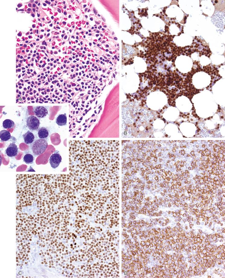 FIGURE 12-15, Plasma cell myeloma, small lymphocyte-like variant: microscopic and immunohistochemical features.