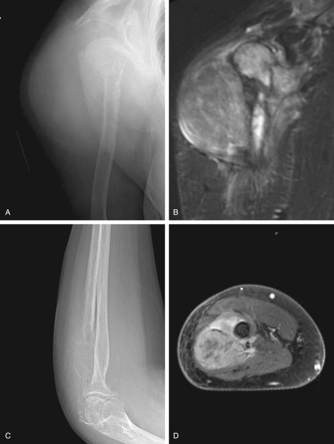 FIGURE 12-28, Non-Hodgkin's lymphoma of bone: radiographic features.