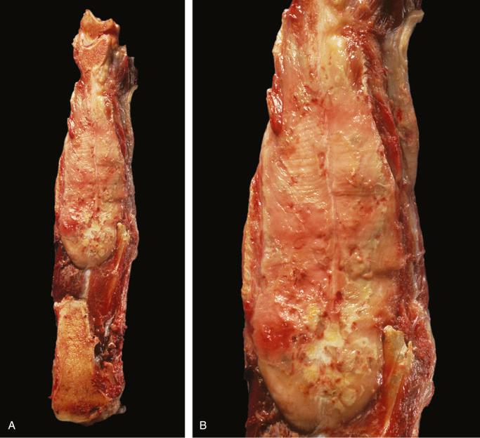 FIGURE 12-29, Non-Hodgkin's lymphona of bone: gross features.