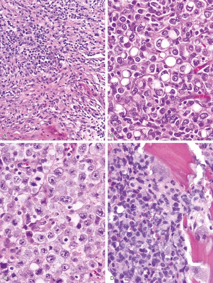 FIGURE 12-30, Diffuse large B-cell lymphoma of bone: microscopic features.