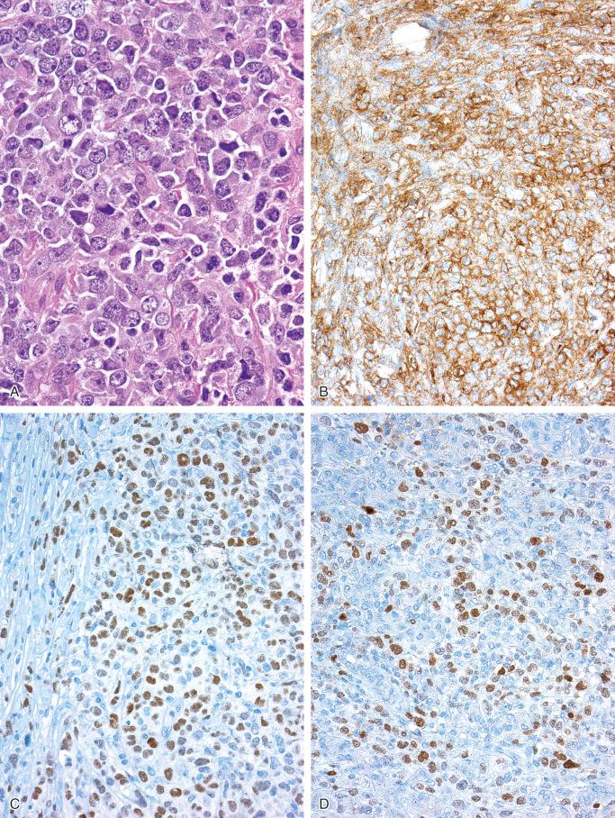 FIGURE 12-31, Diffuse large B-cell lymphoma of bone, germinal center type: microscopic and immunohistochemical features.