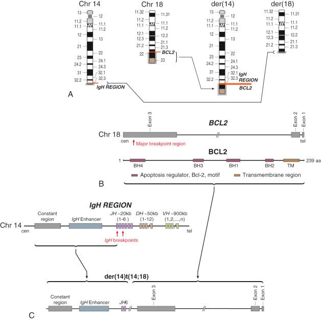 FIGURE 12-34, t(14;18)(q32.3:q21.3) in diffuse large B-cell lymphoma.