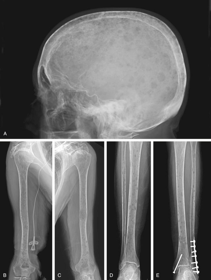 FIGURE 12-6, Plasma cell myeloma: radiographic features.