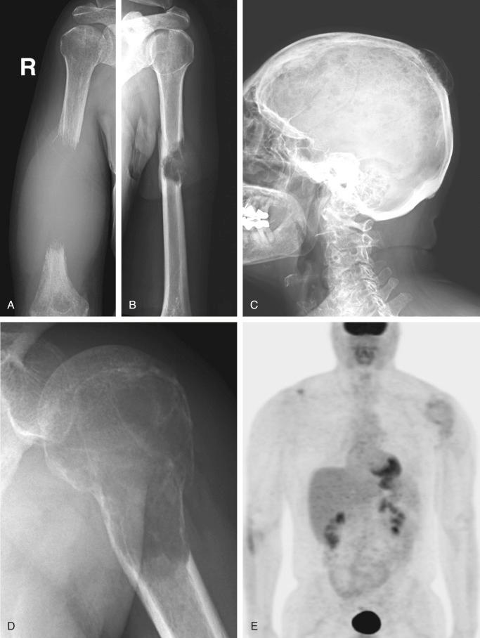 FIGURE 12-7, Plasma cell myeloma: radiographic features.