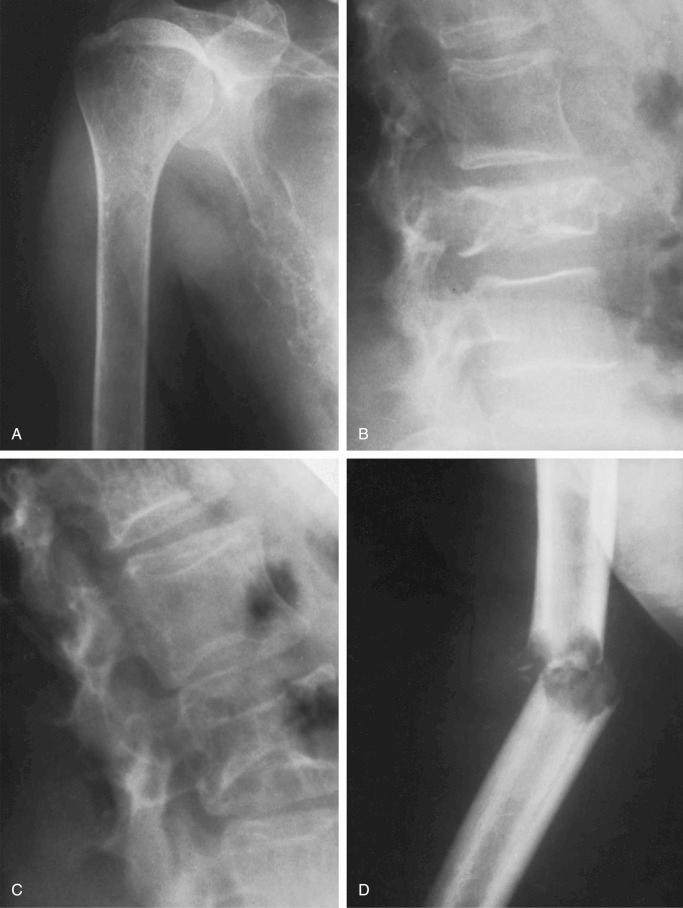 FIGURE 12-9, Plasma cell myeloma: radiographic features.