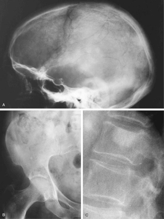 FIGURE 12-10, Sclerosing plasma cell myeloma: radiographic features.