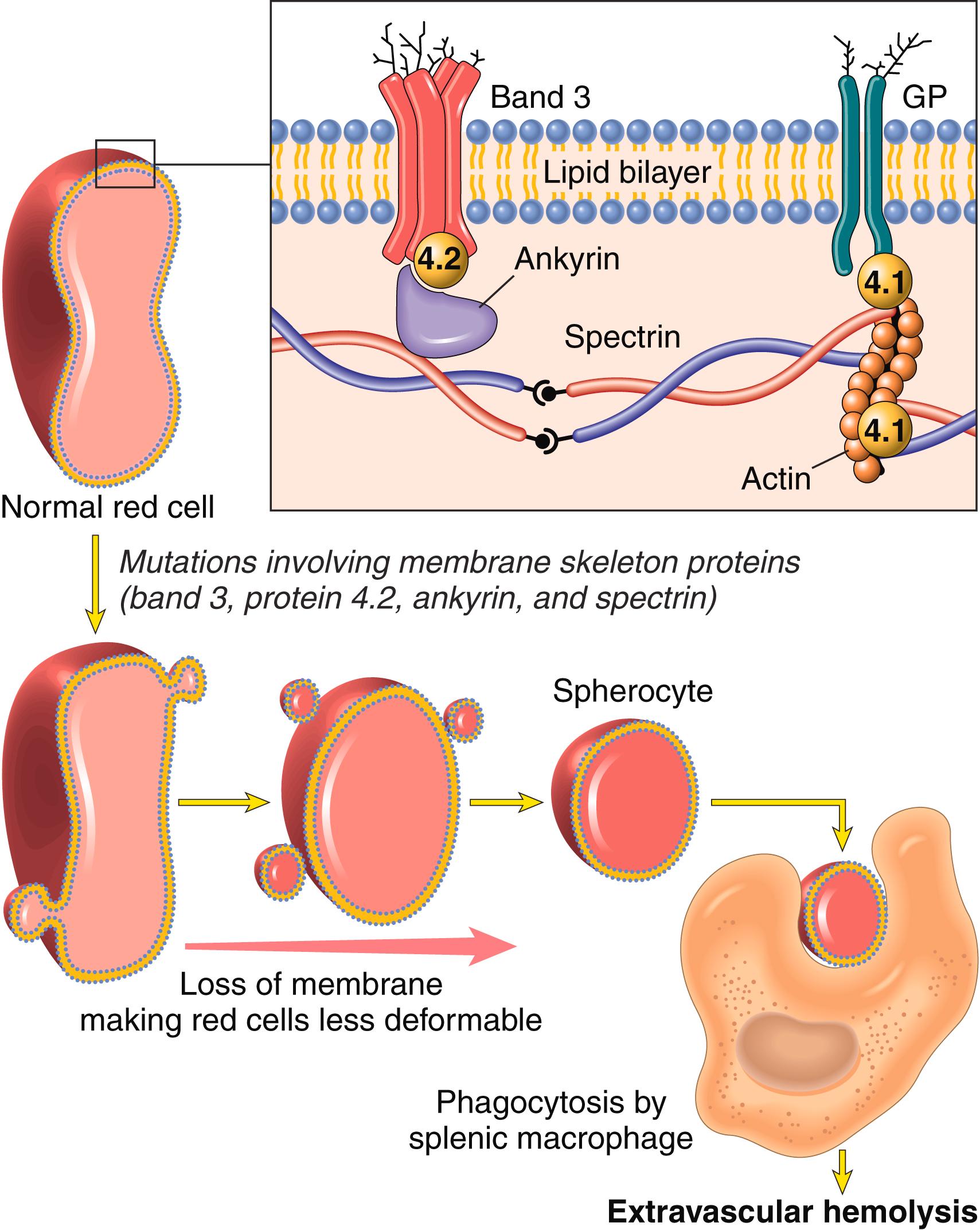 FIG. 10.1, Pathogenesis of hereditary spherocytosis. (Top) Normal organization of the major red cell membrane skeleton proteins. Mutations in spectrin, ankyrin, band 4.2, and band 3 that weaken the association of the membrane skeleton with the overlying plasma membrane cause red cells to shed membrane vesicles and transform into spherocytes (bottom) . The nondeformable spherocytes are trapped in the splenic cords and phagocytosed by macrophages. GP, Glycophorin.