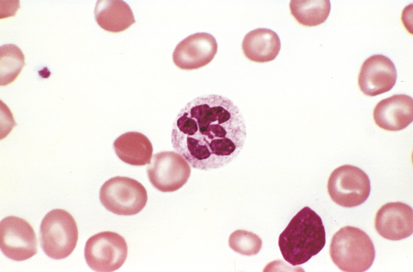 FIG. 10.11, Megaloblastic anemia. A peripheral blood smear shows a hypersegmented neutrophil with a six-lobed nucleus.