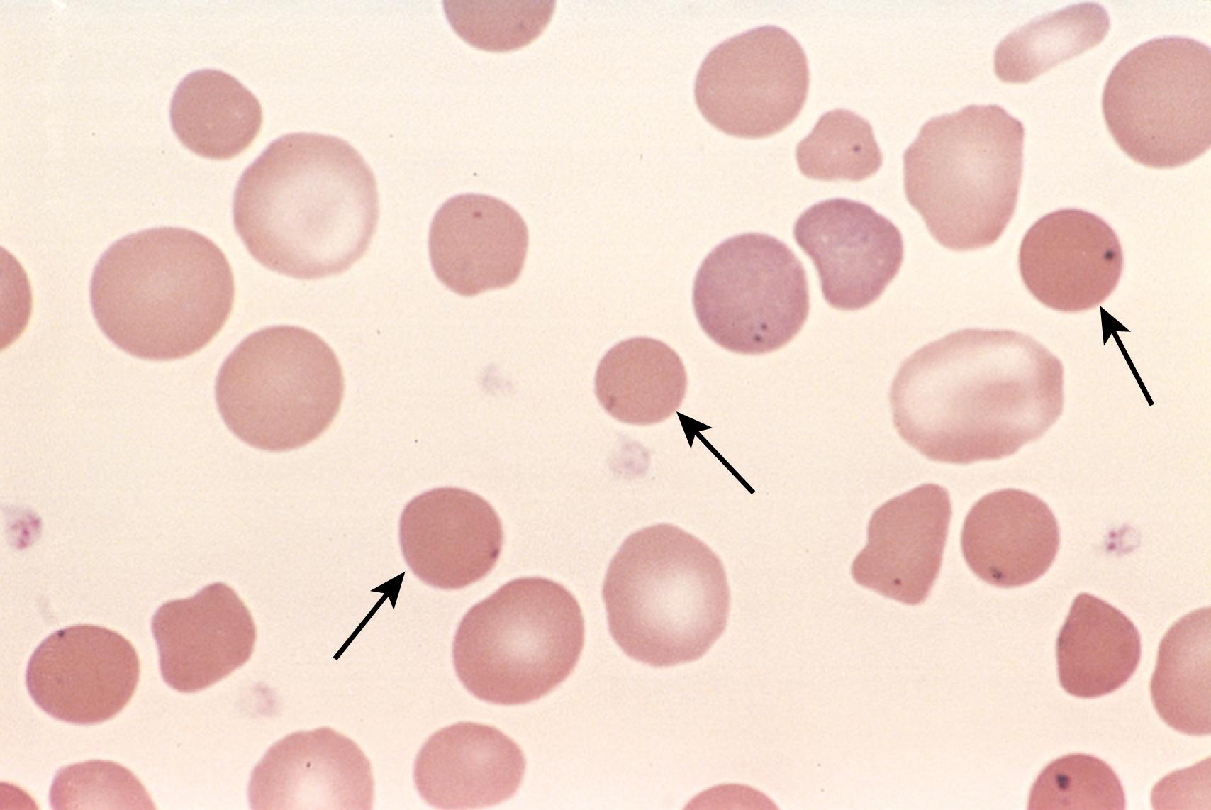 FIG. 10.2, Hereditary spherocytosis—peripheral blood smear. Note the anisocytosis and several hyperchromic spherocytes (arrows) . Howell-Jolly bodies (small nuclear remnants, which appear as small dark inclusions) are also present in the red cells of this asplenic patient.