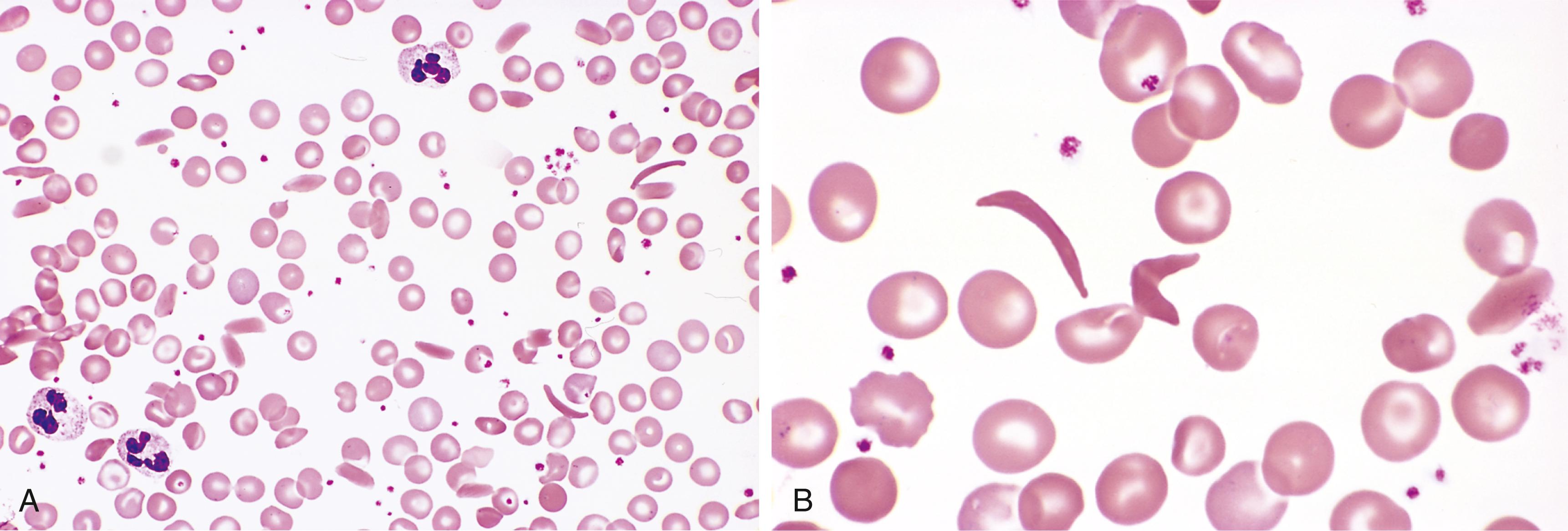 FIG. 10.3, Sickle cell anemia—peripheral blood smear. (A) Low magnification shows sickle cells, anisocytosis, poikilocytosis, and target cells. (B) Higher magnification shows two irreversibly sickled cells in the center.