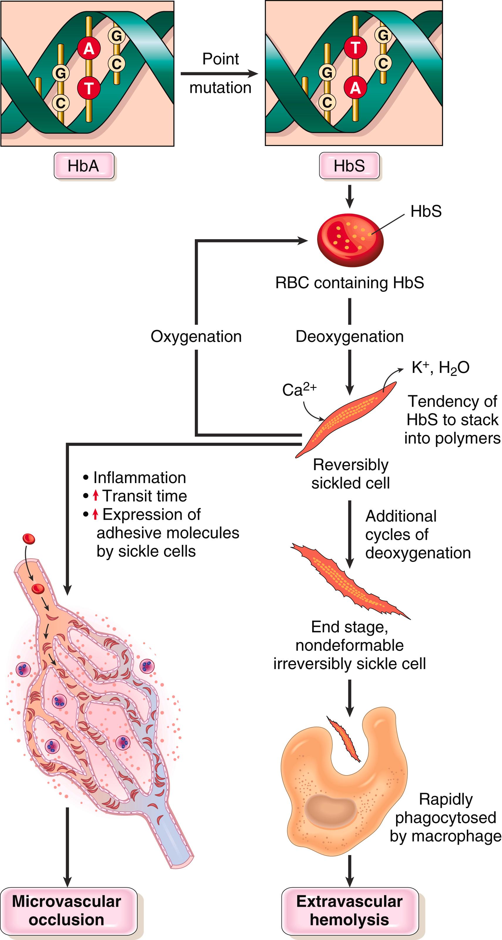 FIG. 10.4, Pathophysiology of sickle cell disease.