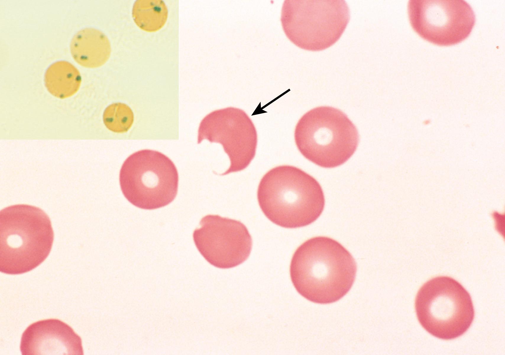 FIG. 10.6, Glucose-6-phosphate dehydrogenase deficiency after oxidant drug exposure—peripheral blood smear. (Inset) Red cells with precipitates of denatured globin (Heinz bodies) shown by supravital staining. As the splenic macrophages pluck out these inclusions, “bite cells” (arrow) similar to the one in this smear are produced.