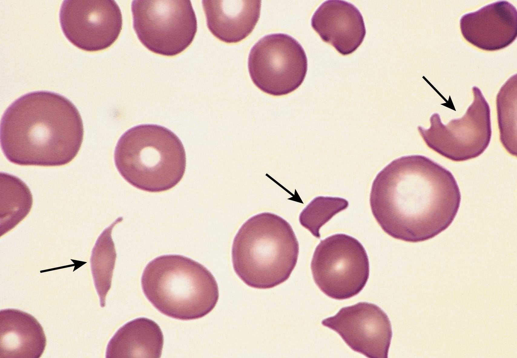 FIG. 10.7, Microangiopathic hemolytic anemia—peripheral blood smear. This specimen from a patient with hemolytic uremic syndrome contains several fragmented red cells (arrows) .