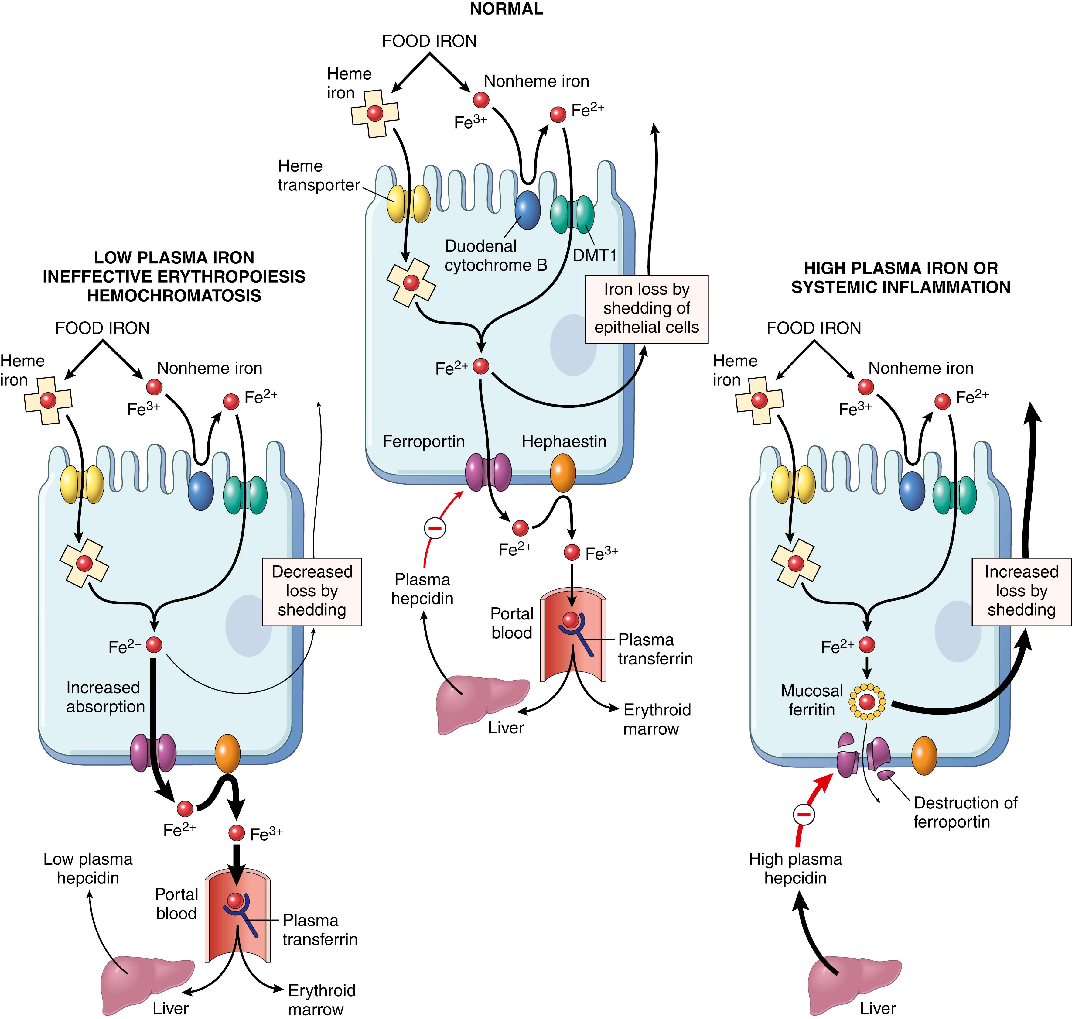 FIG. 10.9, Regulation of iron absorption. Duodenal epithelial cell uptake of heme and nonheme iron is depicted. When the storage sites of the body are replete with iron and erythropoietic activity is normal, plasma hepcidin balances iron uptake and loss to maintain iron hemostasis by downregulating ferroportin and limiting iron uptake (middle panel). Hepcidin rises in the setting of systemic inflammation or when iron levels are high, decreasing iron uptake and increasing iron loss by the shedding of duodenocytes (right panel), whereas it falls in the setting of low plasma iron or primary hemochromatosis, resulting in increased iron uptake (left panel). DMT1, Divalent metal transporter-1.