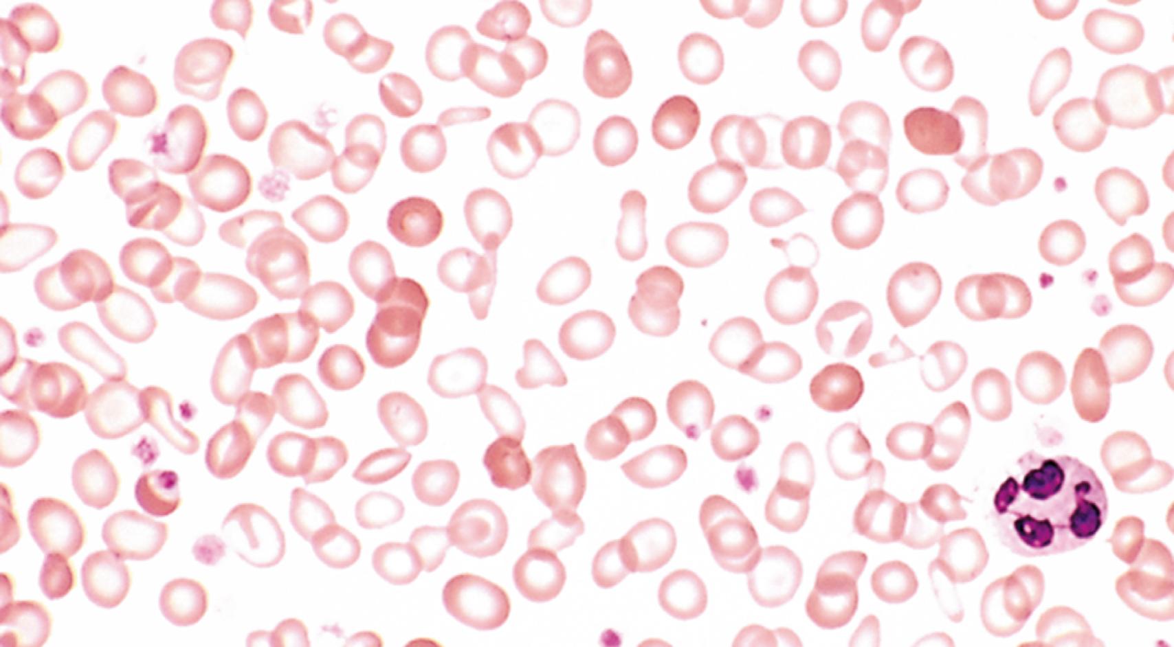 FIG. 10.10, Iron deficiency anemia—peripheral blood smear. Note the increased central pallor of most of the red cells. Scattered fully hemoglobinized cells, from a recent blood transfusion, stand out in contrast.