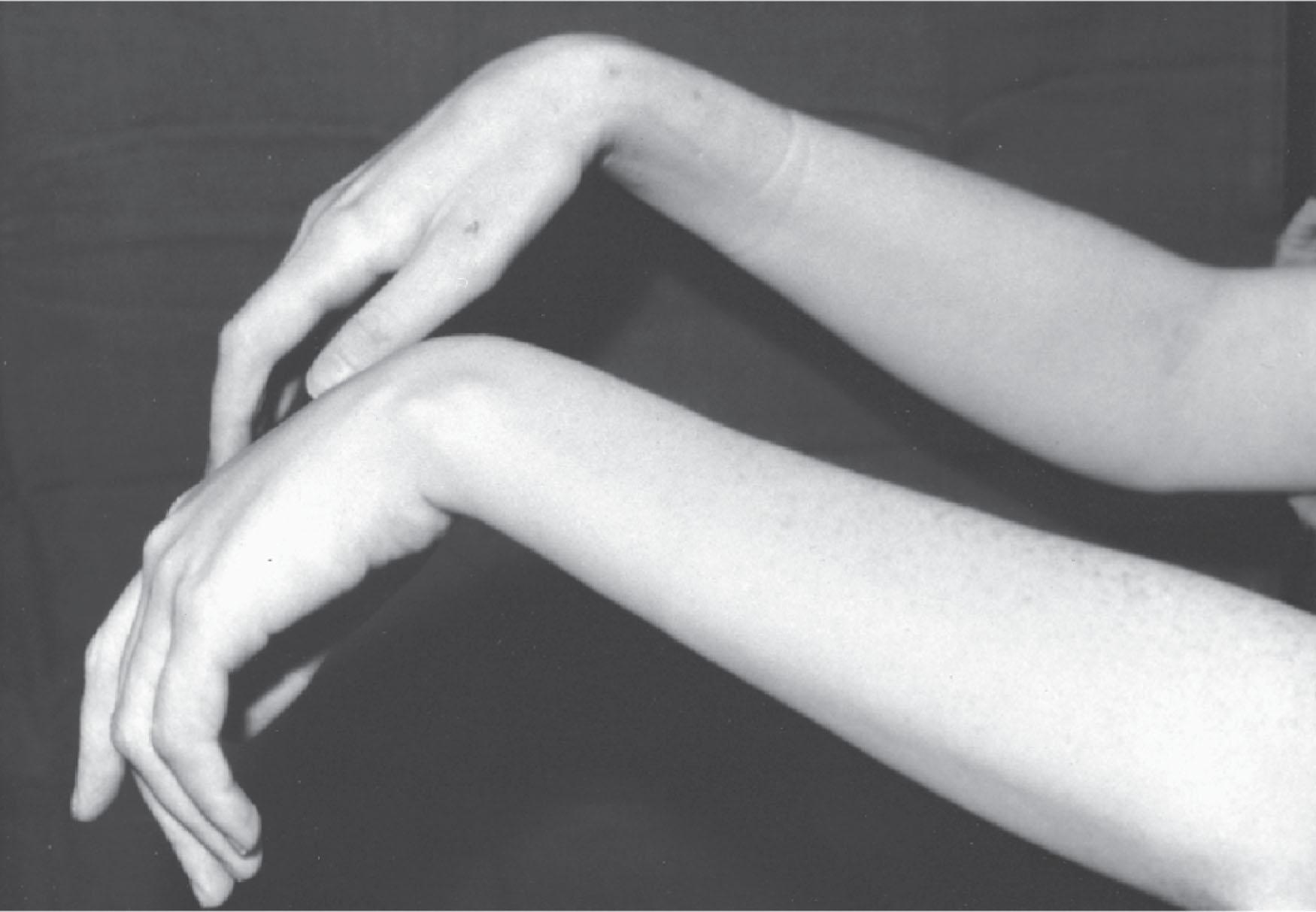 Figure 39.4, BILATERAL WRISTDROP CAUSED BY PERIPHERAL NEUROPATHY IN A PATIENT WITH ACUTE INTERMITTENT PORPHYRIA.