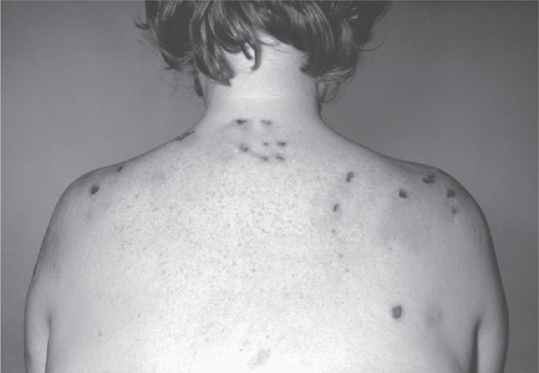 Figure 39.5, CUTANEOUS LESIONS AND SCARRING IN A PATIENT WITH VARIEGATE PORPHYRIA.