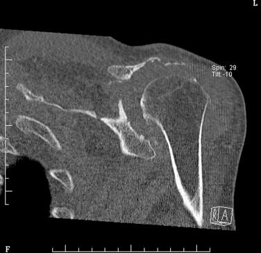 FIG. 38.1, A 75-year-old man with massive glenoid and acromial erosion secondary to rotator cuff arthropathy.