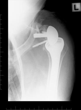 FIG. 38.2, Immediate postoperative radiograph showing reverse shoulder arthroplasty. Allograft femoral head was used to address the glenoid bone deficiency, combined with a long central peg glenoid base plate.