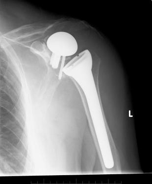 FIG. 38.3, Postoperative radiograph obtained 3 days after surgery showing a failed glenoid component.