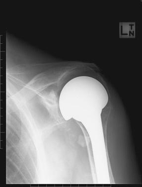 FIG. 38.4, Postoperative radiograph obtained 4 months after surgery showing satisfactory alignment and associated clinical outcome using a large humeral head component to convert the failed reverse shoulder arthroplasty to a hemiarthroplasty.