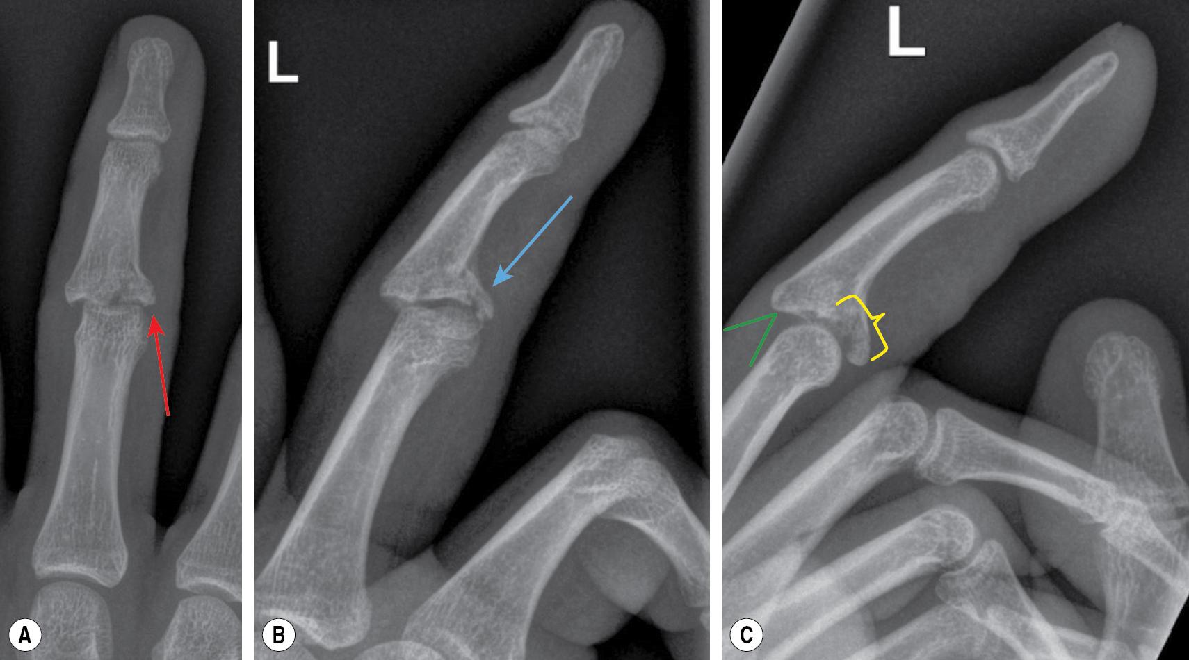 FIGURE 13.2, Anteroposterior (AP), oblique, and lateral views of this left middle phalanx fracture-dislocation show loss of proximal interphalangeal (PIP) joint articular surface continuity. (A) The AP view shows a comminuted fracture of the radial plateau of the middle phalanx with loss of height ( red arrow ). (B) The oblique view demonstrates the loss of joint congruity and loss of the buttressing effect of the volar lip ( blue arrow ). (C) The lateral view demonstrates the dorsal subluxation or “V sign” ( green angle ) and approximately 50% destruction of the volar lip ( yellow bracket ).