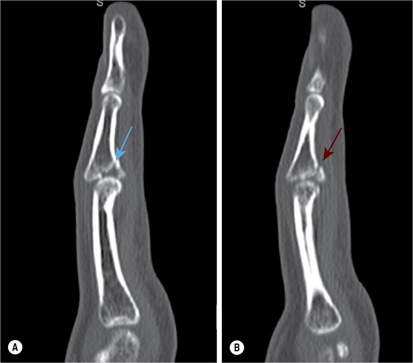 FIGURE 13.3, A Severe impaction of the middle phalanx articular surface can be clearly seen ( blue arrow ) as well as comminution of the volar cortex and articular surface ( red arrow ).