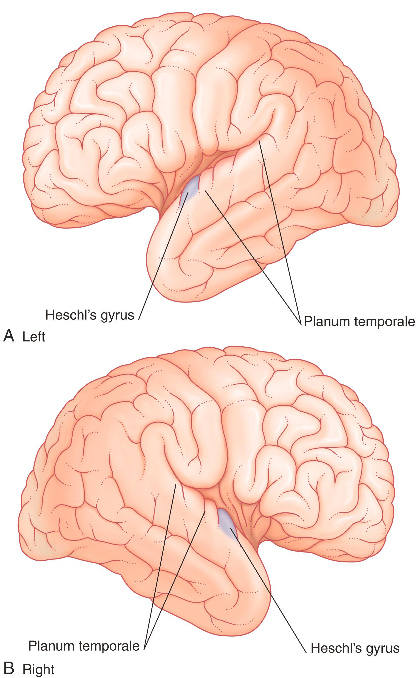 Fig. 32.2, Views of the opened lateral sulcus, showing the upper surface of the temporal lobes.