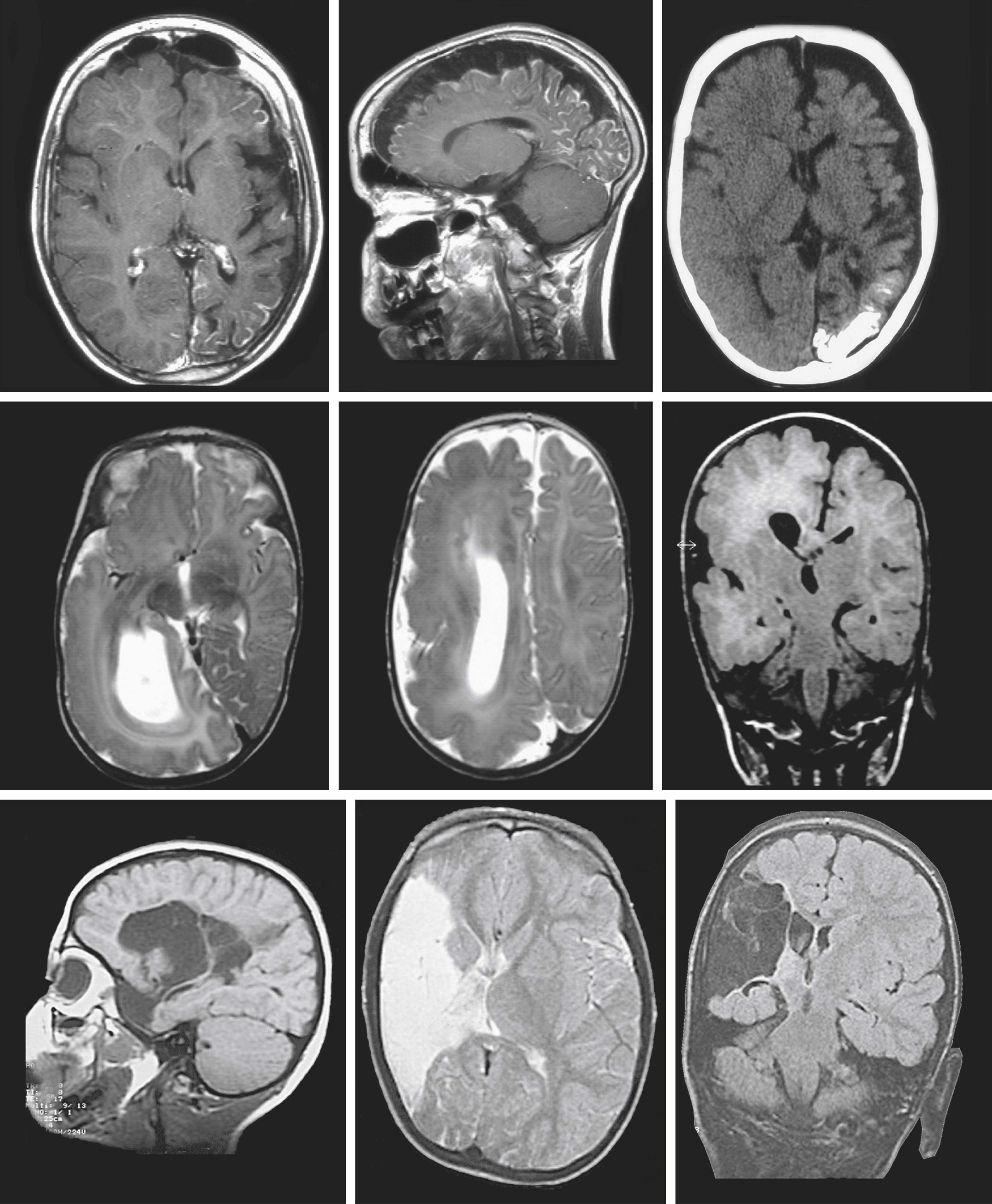 Figure 99.1, MR images and CT scans from three typical causes.