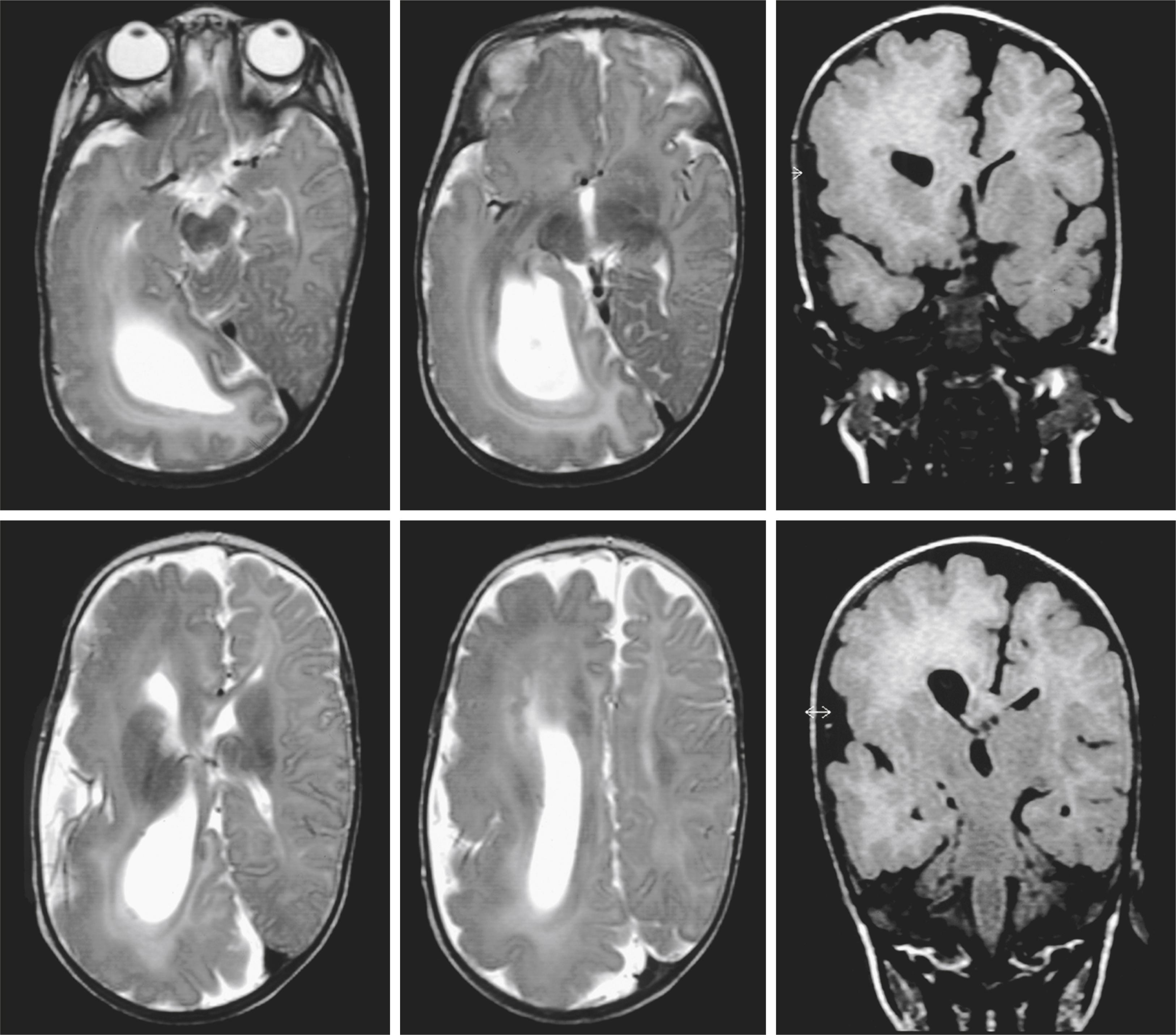 eFigure 99.1, MR images of hemimegalencephaly in a 17-month-old girl.