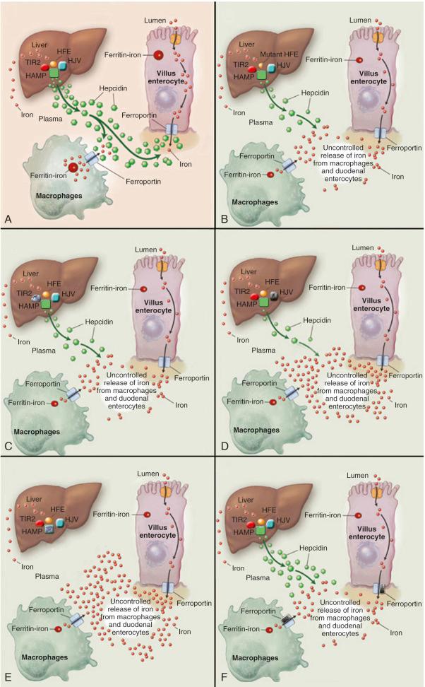 Fig. 60-3, Hepcidin as the central hormone in hemochromatosis.