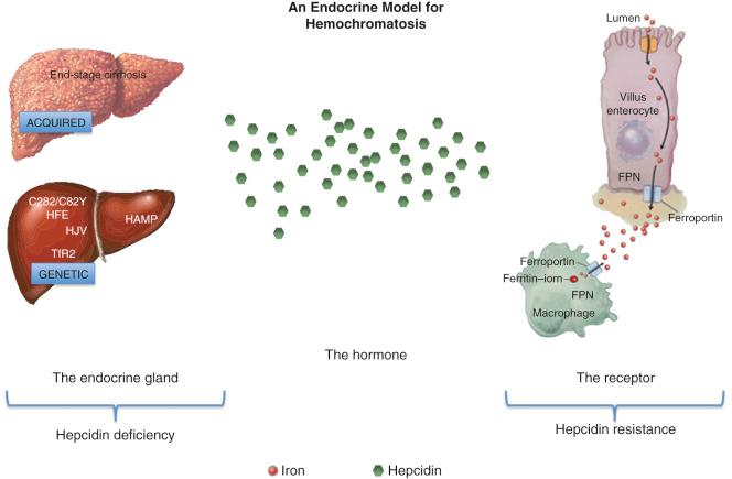 Fig. 60-4, Hemochromatosis as an endocrine disease.